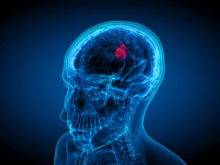 Beyin Tümörleri